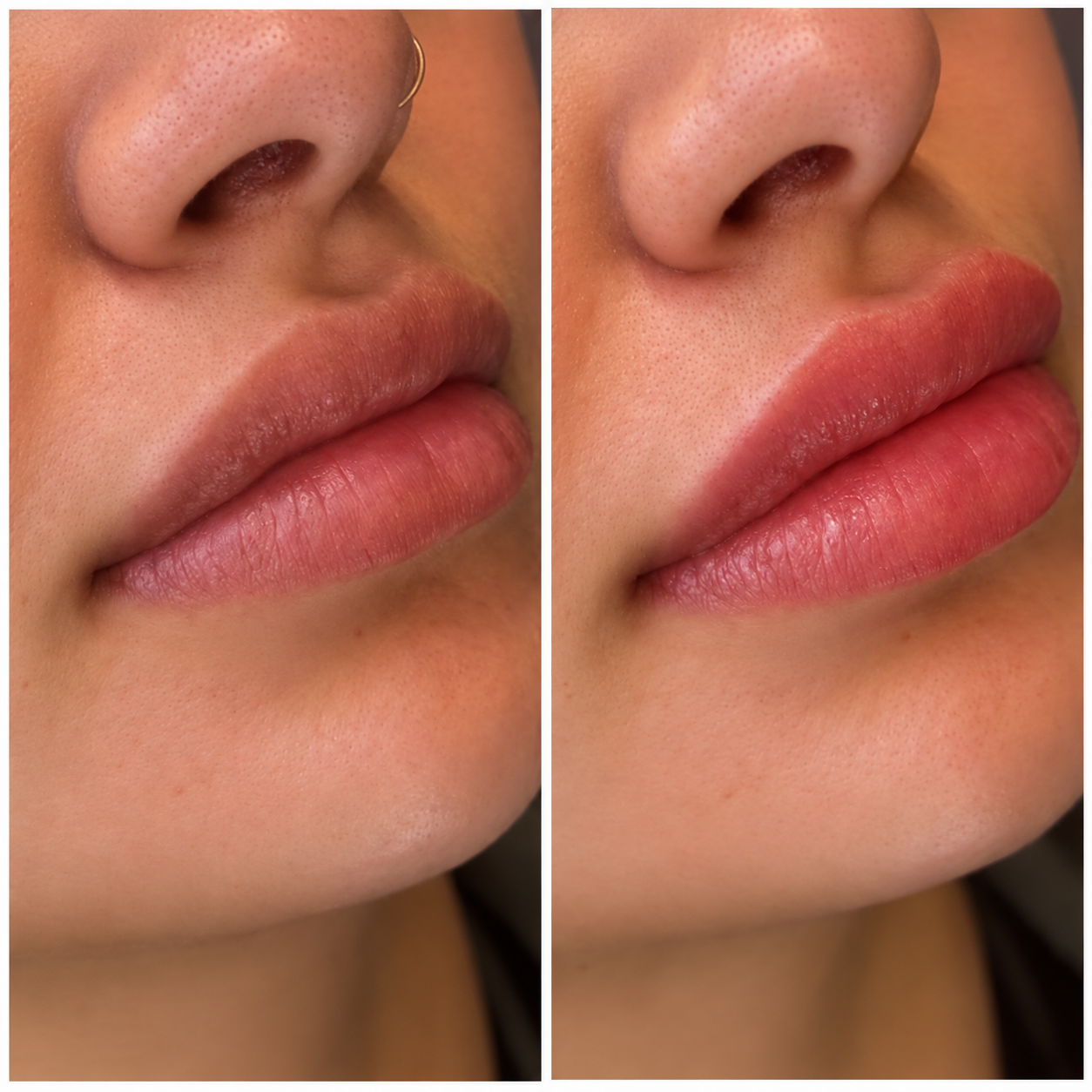 Before and After Lip Enhancement.png