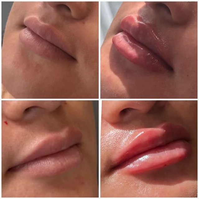 Before-and-after lip filler photos showing enhanced lip volume and definition from a side angle.