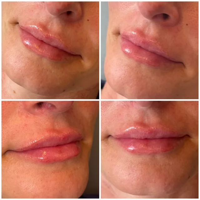 Four before-and-after lip filler photos highlighting changes in lip fullness, symmetry, and definition from multiple angles.