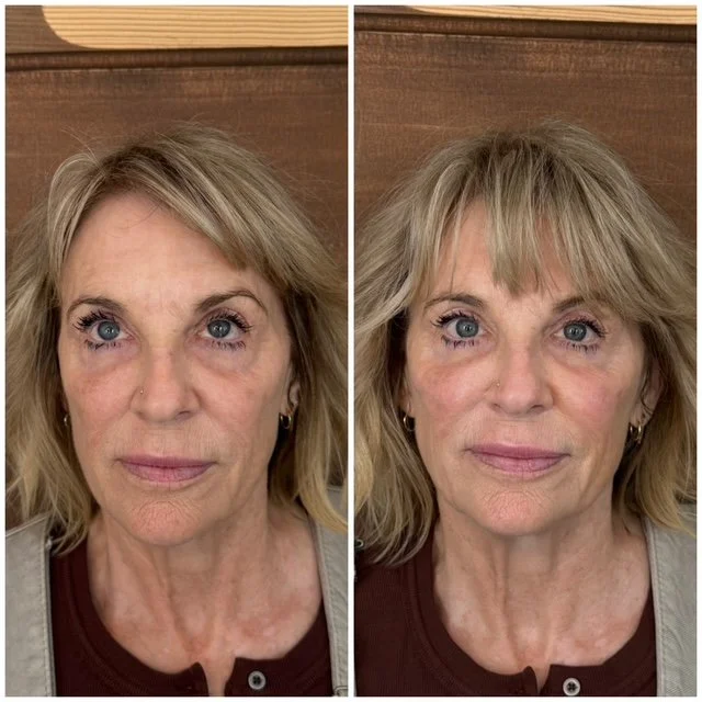Before-and-after medical aesthetics photos showing changes in a woman's facial appearance and skin texture.