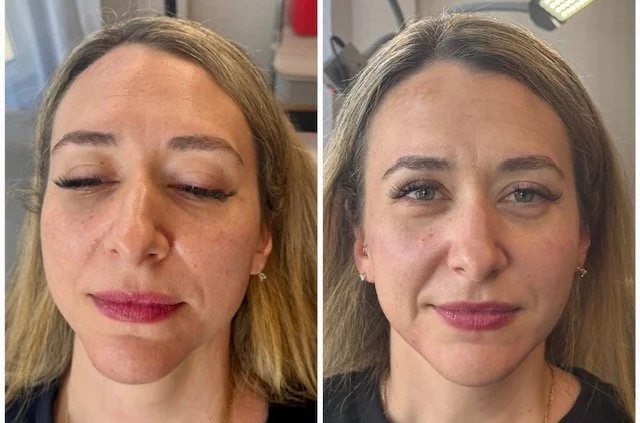 Before-and-after facial rejuvenation photos showing changes in skin texture and facial contours from the front.
