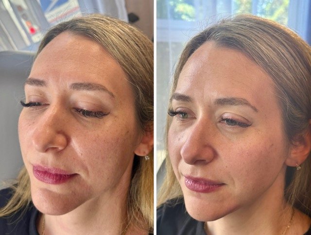 Before-and-after facial rejuvenation photos showing changes in skin texture and facial contours from an angle.