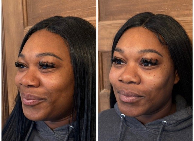 Before-and-after facial rejuvenation photos showing changes in skin texture and facial contours from an angle.