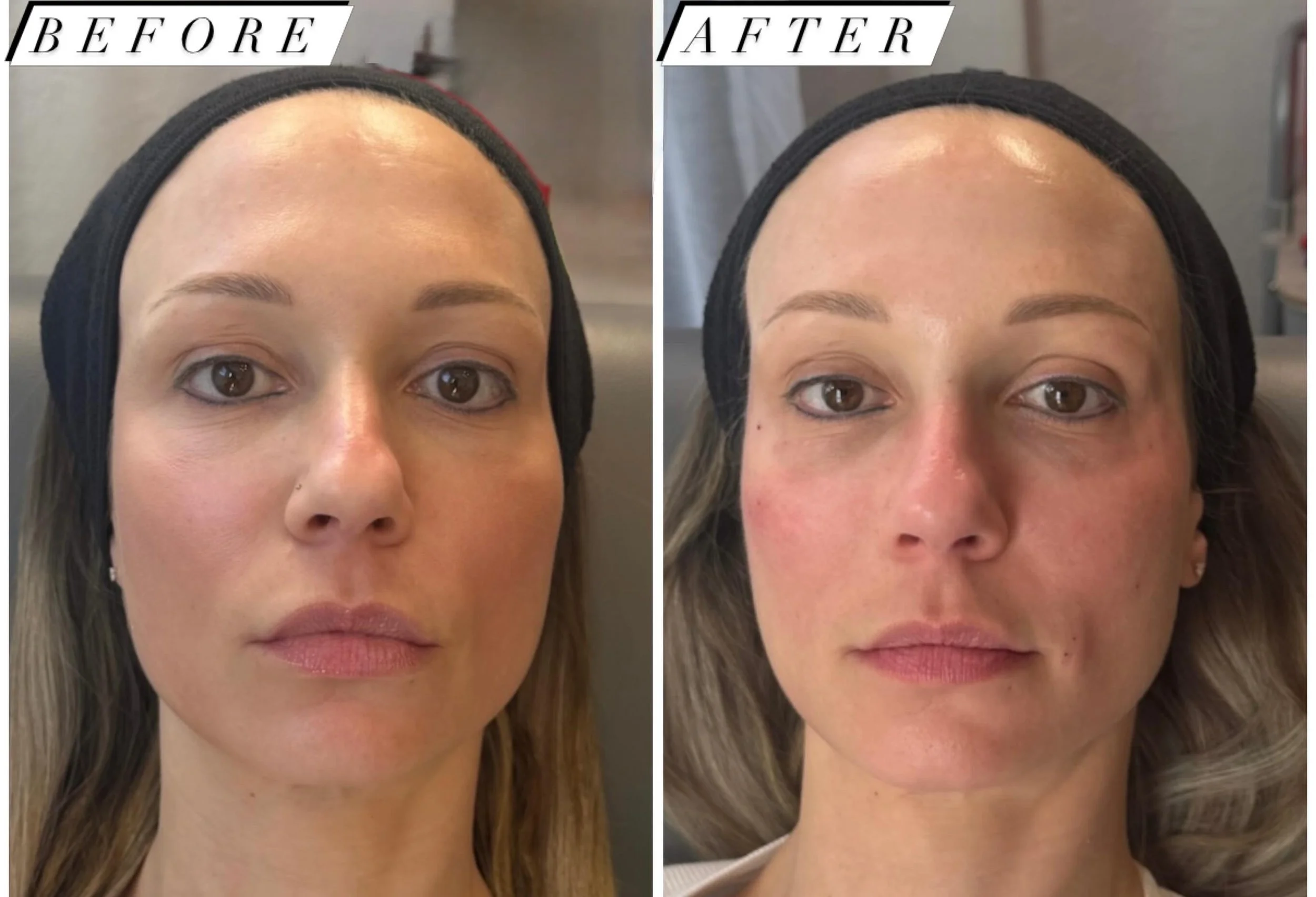 Before-and-after facial skin treatment photos comparing skin tone and texture from the front.