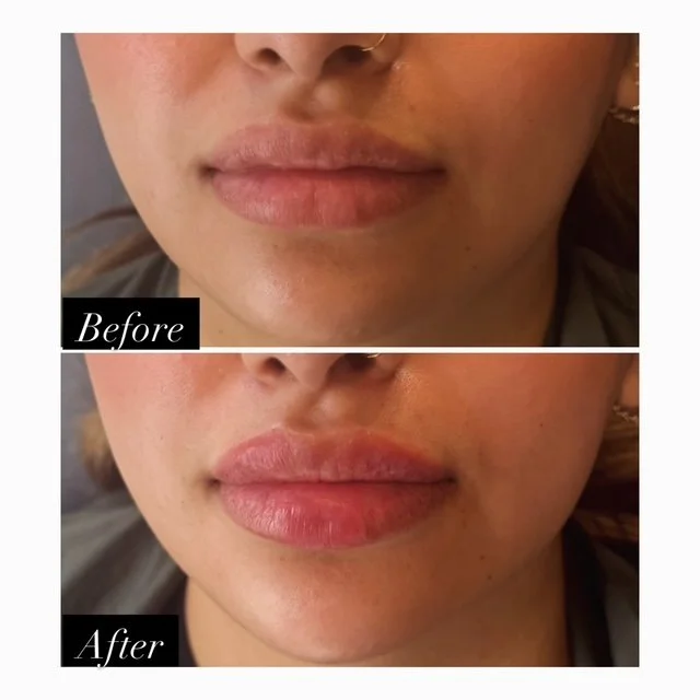 Before-and-after lip filler photos showing increased lip volume and definition from the front.