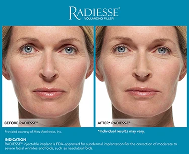 Before-and-after comparison showing improved facial volume and softened wrinkles following Radiesse dermal filler treatment.