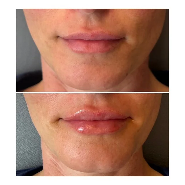 Close-up of a person's lips before and after cosmetic lip enhancement, showing increased volume and a glossy finish in the second image.