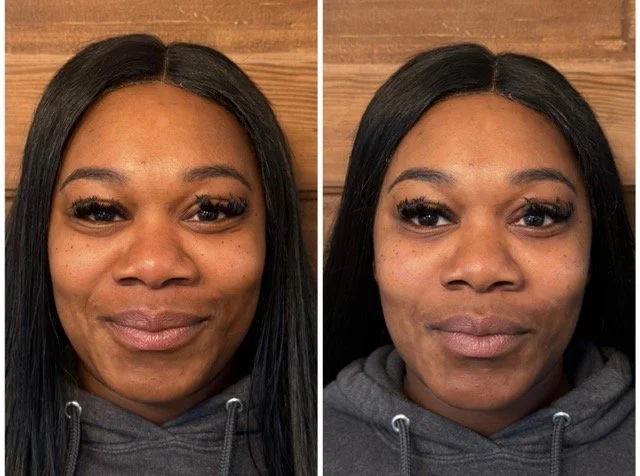 Before-and-after facial rejuvenation photos showing changes in skin texture and facial contours from the front.