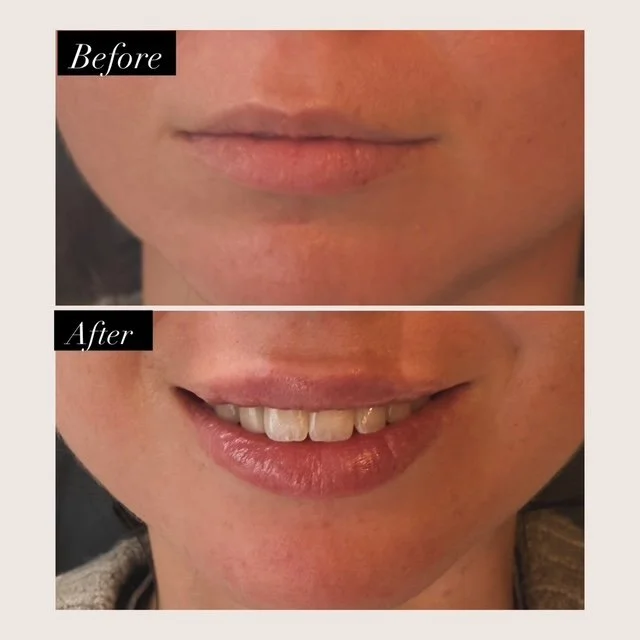 Before-and-after lip enhancement photos showing fuller, more defined lips and a smiling after photo.