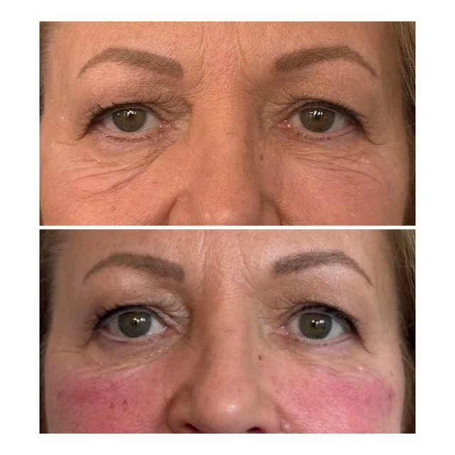 Close-up of a woman's eyes before and after treatment showing reduction in wrinkles and skin redness.