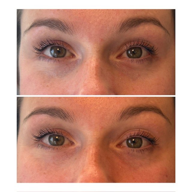 Before-and-after close-up images highlighting changes in the appearance of the skin around the eyes and eyebrows.