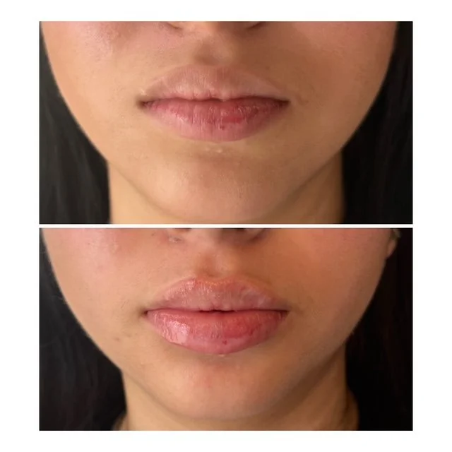 Before-and-after lip filler results showing fuller, more defined lips with natural-looking volume from the front.