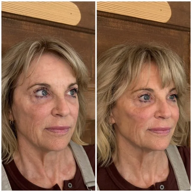 Before-and-after facial rejuvenation photos comparing a woman's skin texture and cheek contours from a side angle.