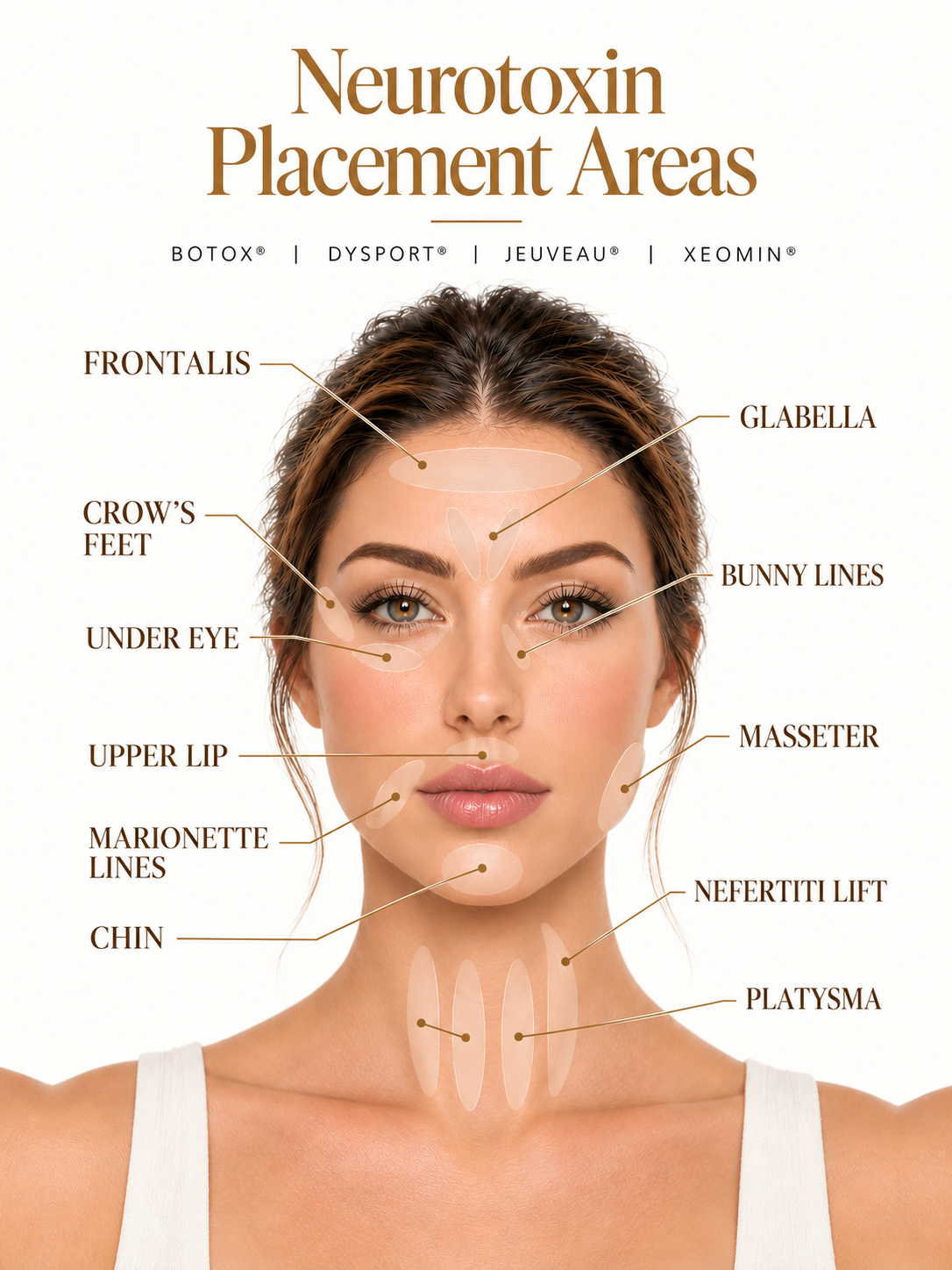 Facial diagram showing common Botox and neurotoxin injection areas, including forehead lines, crow's feet, chin, and jawline.