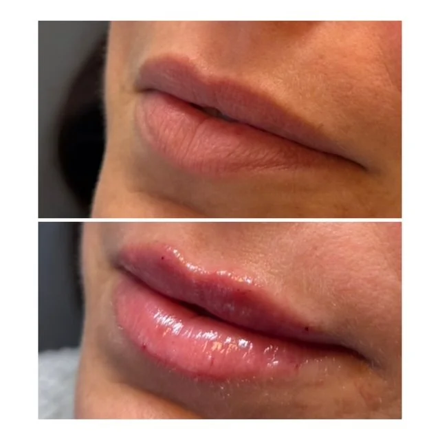 Before-and-after lip filler treatment showing enhanced lip volume, shape, and definition from an angled view.