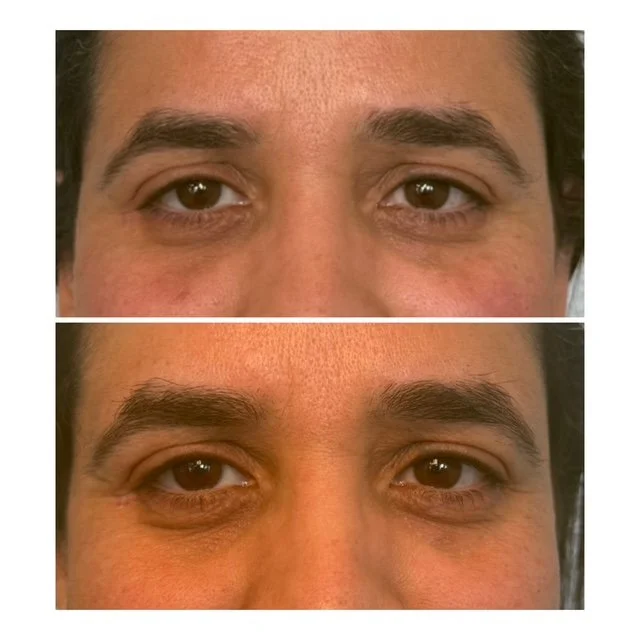 Comparison of eyes showing before and after of aesthetics treatment, with visible reduction in eyelid drooping.