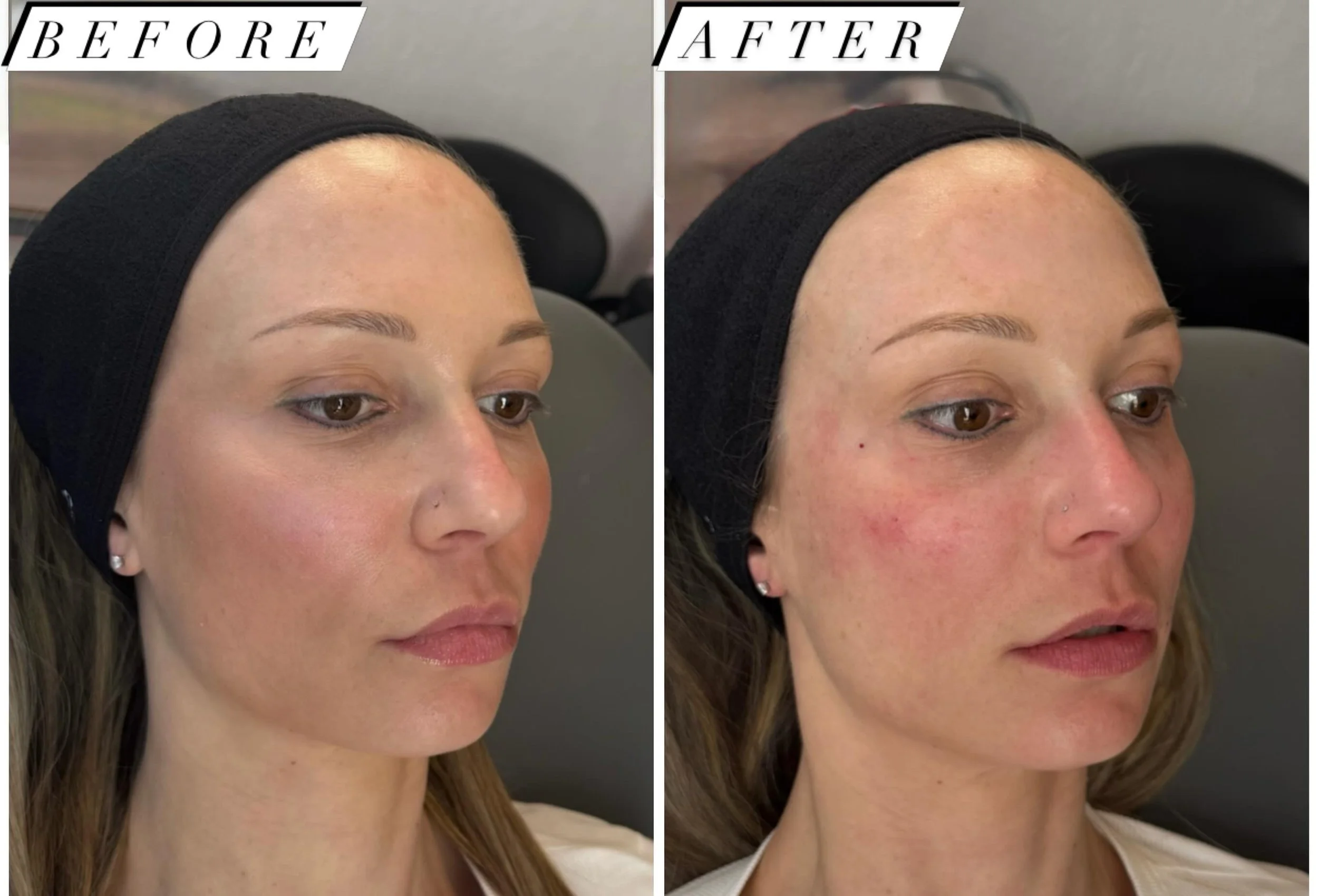 Before-and-after facial skin treatment photos showing differences in cheek redness and skin appearance from an angled view.