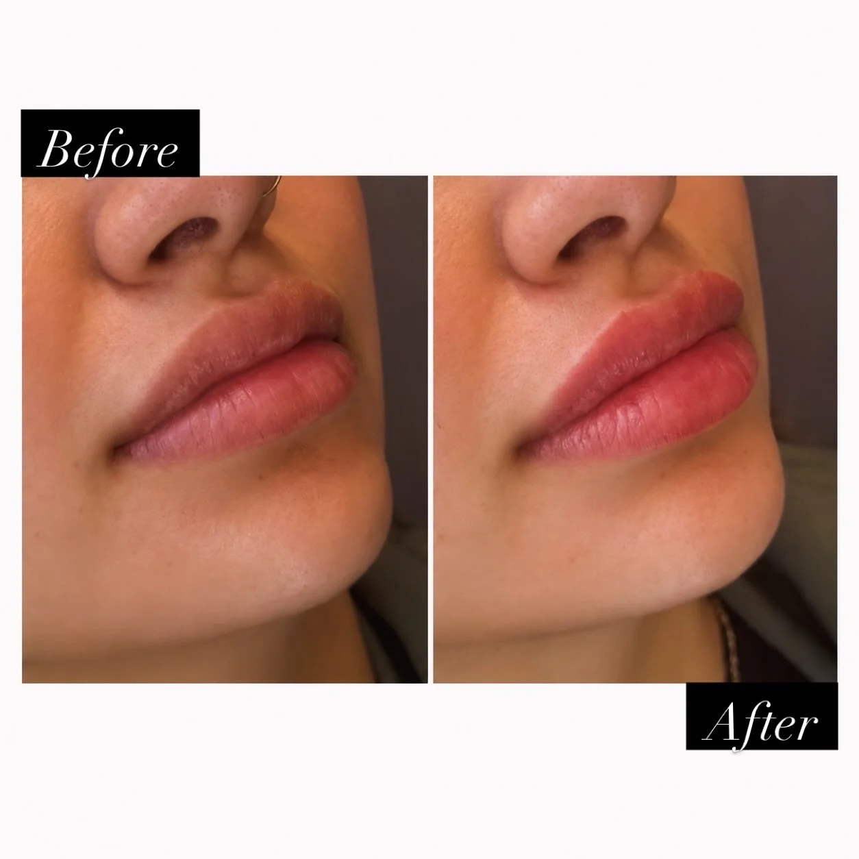 Before-and-after lip filler photos showing enhanced lip volume and definition from a side angle.
