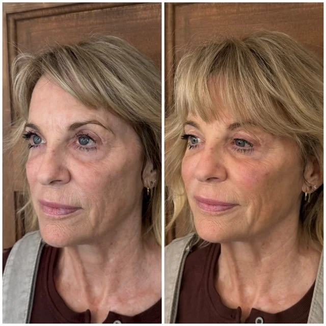 Before-and-after facial rejuvenation photos showing changes in a woman's cheek contours and facial appearance from an angled view.