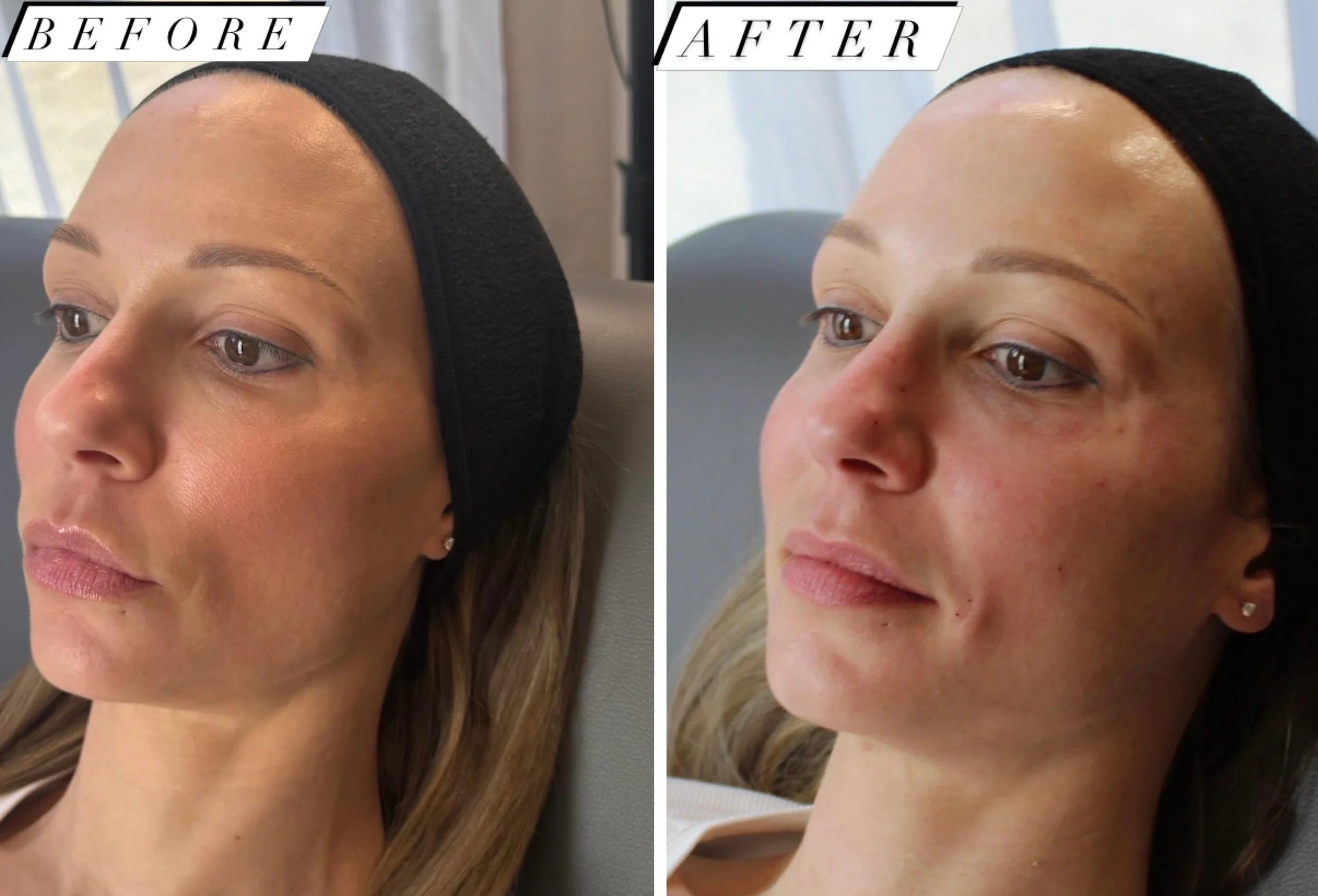 Before-and-after facial skin rejuvenation photos showing changes in skin texture and appearance from an angled view.