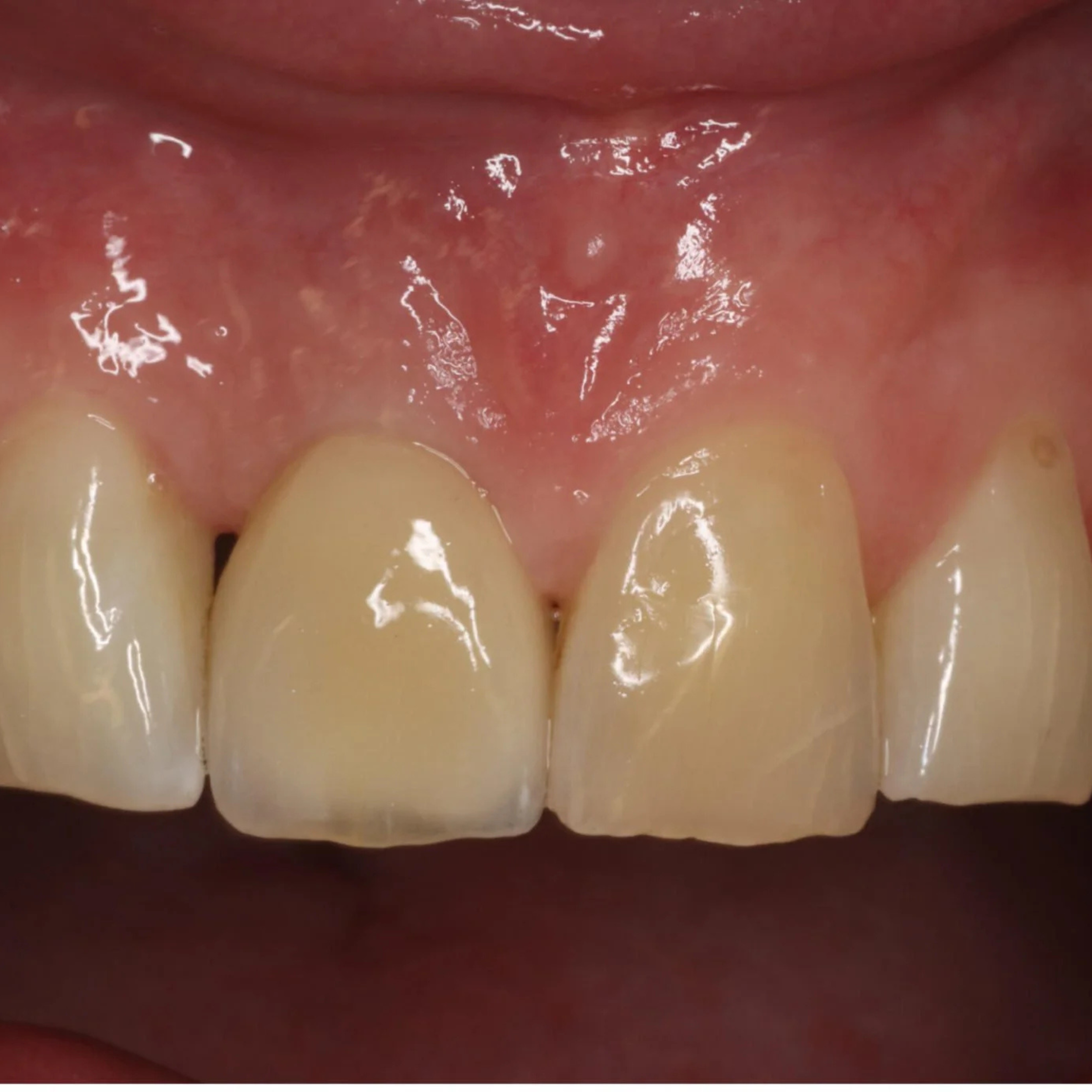 Implant Placement and Simultaneous Bone Grafting in the Aesthetic Zone