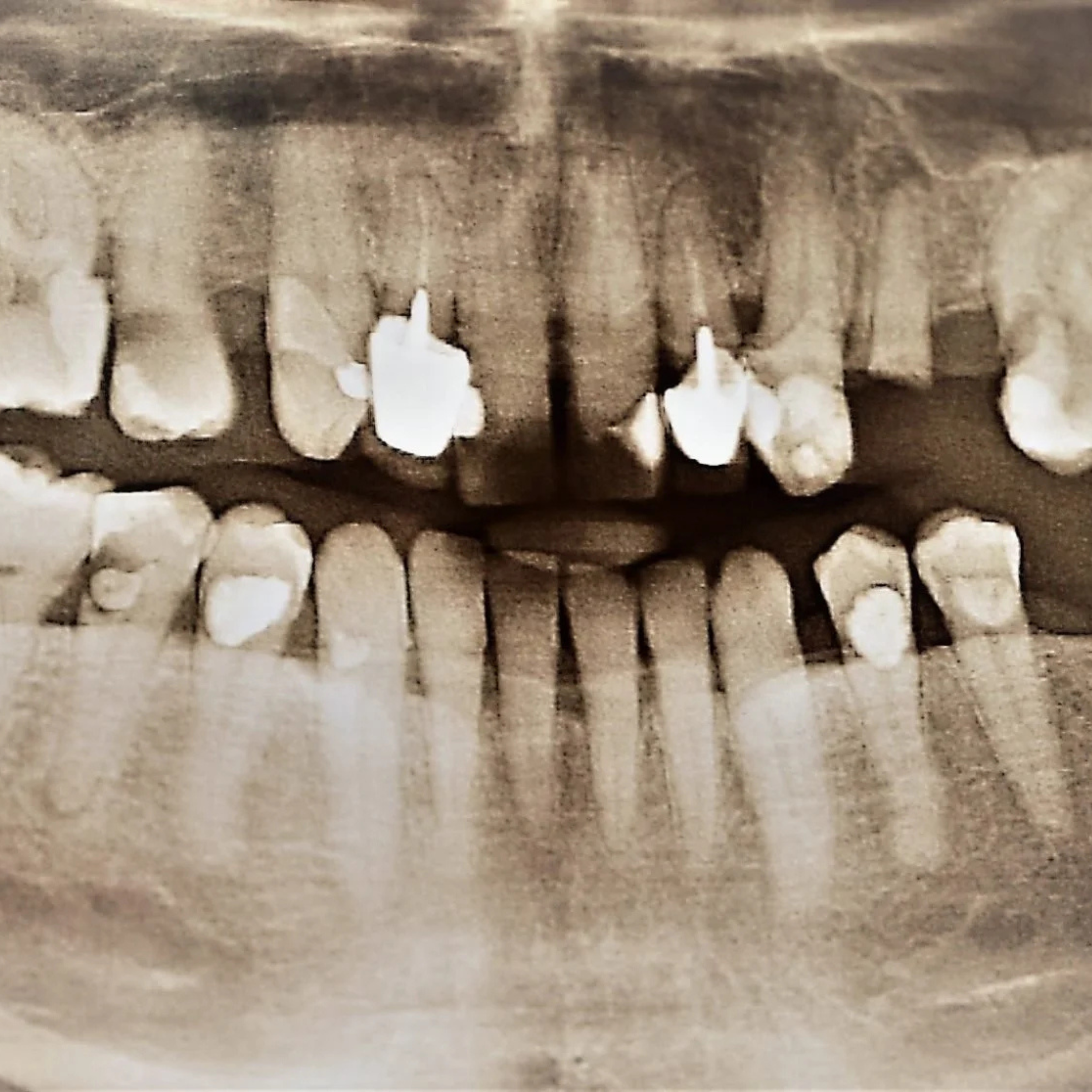 Complete Maxillary Implant-Supported Bridge Case