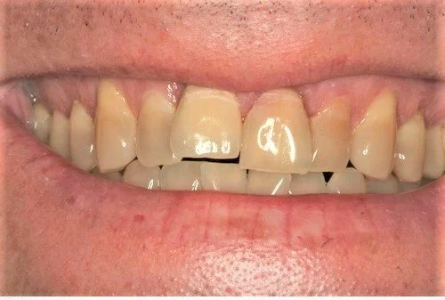 Pre-operative smile line.