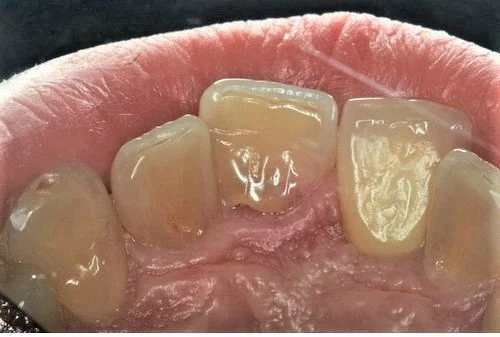 Assessment of interproximal gingival contour.