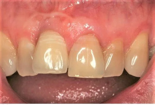 Assessment of interproximal gingival contour.