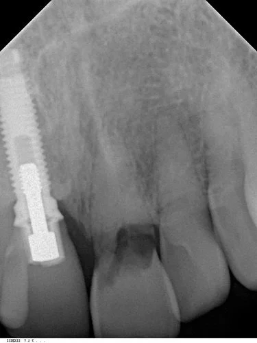 Assessment of interproximal gingival contour.