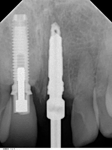 Radiograph of final drill
