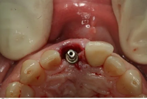 Occlusal view of emergence profile.