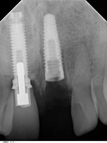 Replace Select implant installed.