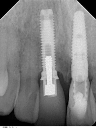 Post op- radiograph of provisional crown.