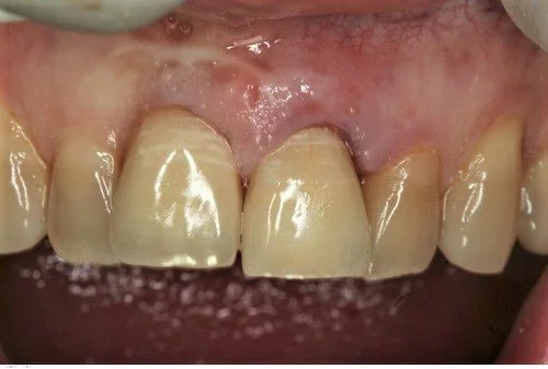 Post operative result one hour after extraction.