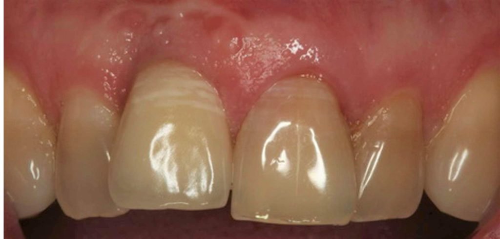 Single Tooth Immediate Placement