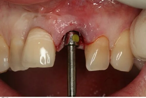 Final drill in drill sequence.