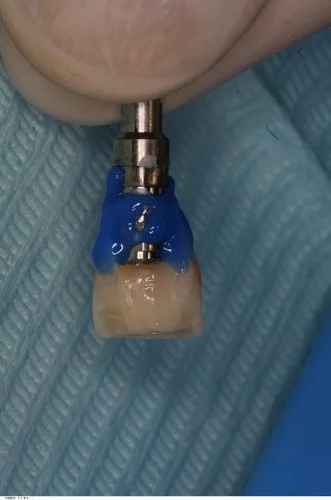 Natural tooth crown being acid etched.