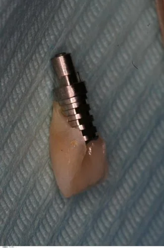 Natural tooth crown being acid etched.
