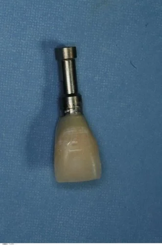 Provisional restoration using natural tooth remnant.