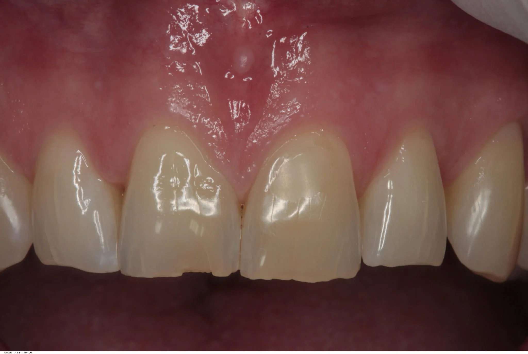 Implant Placement and Simultaneous Bone Grafting in the Aesthetic Zone ...