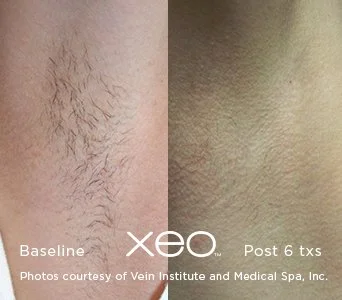 Comparison of skin with hair before and after laser hair removal treatment, showing reduction in hair after six sessions.