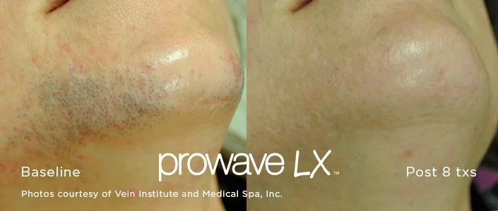 Comparison of skin before and after laser hair removal treatment