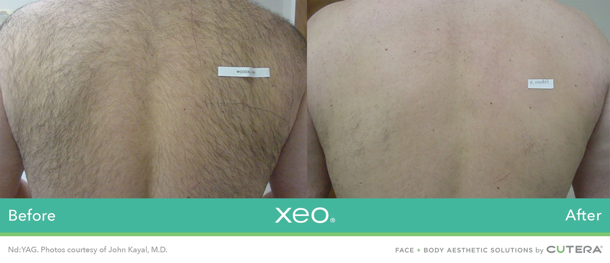 Side-by-side comparison of a person's back before and after laser hair removal