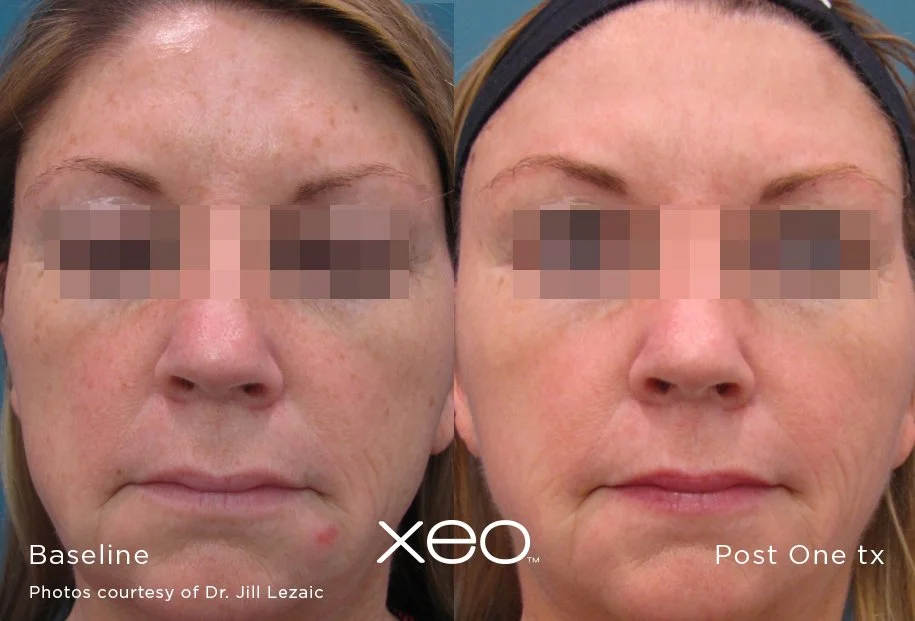 Side-by-side comparison of a woman's face before and after Xeo treatment, showing improvement in skin texture and reduction of blemishes, taken by Dr. Jill Lezaic.