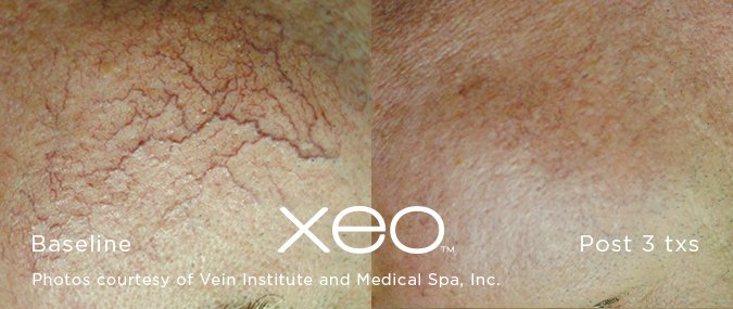 Close-up comparison of skin showing reduced redness and visible veins after xeo laser treatment.