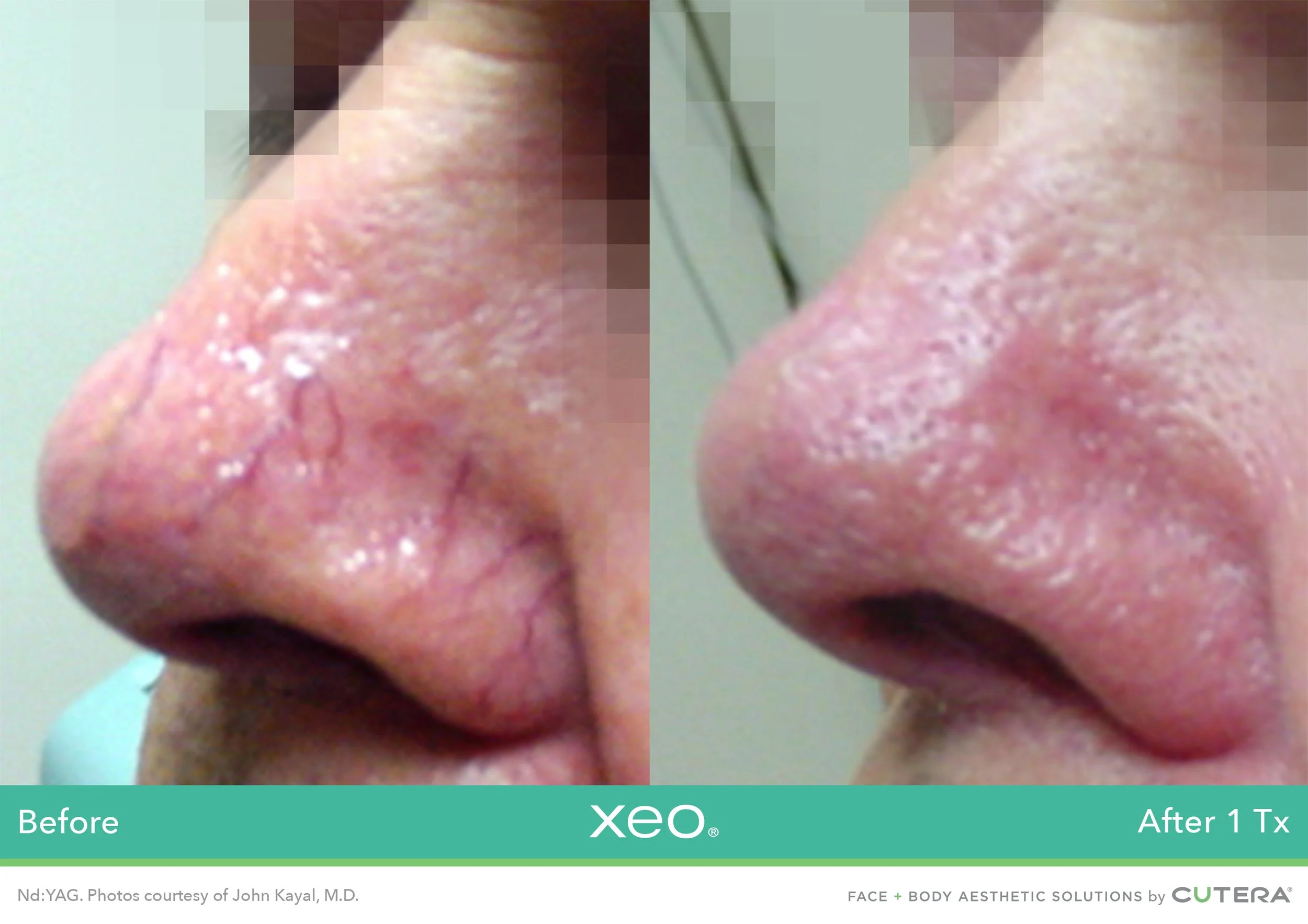 Close-up side view of a person's nose showing skin condition before and after xeo laser treatment
