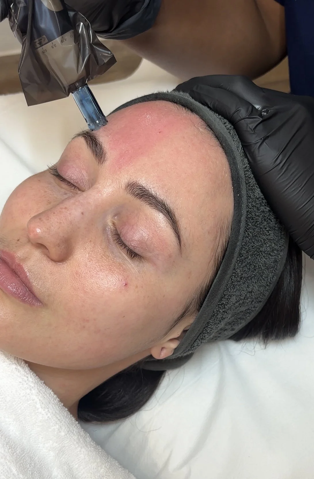 Microneedling Ilkley