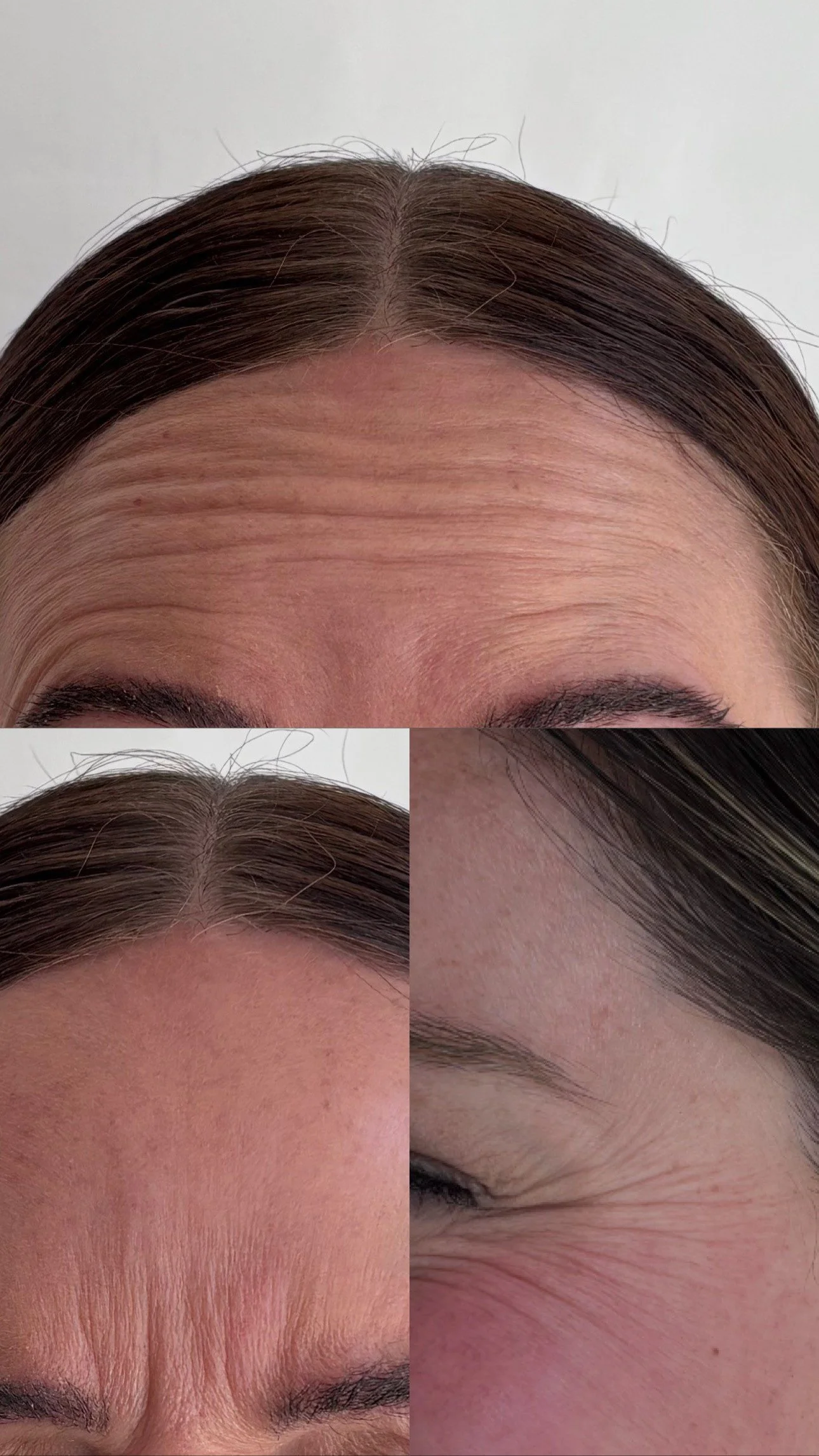 Close-up images of a woman's forehead, hairline, and eye wrinkles, showing the skin's texture and signs of aging.
