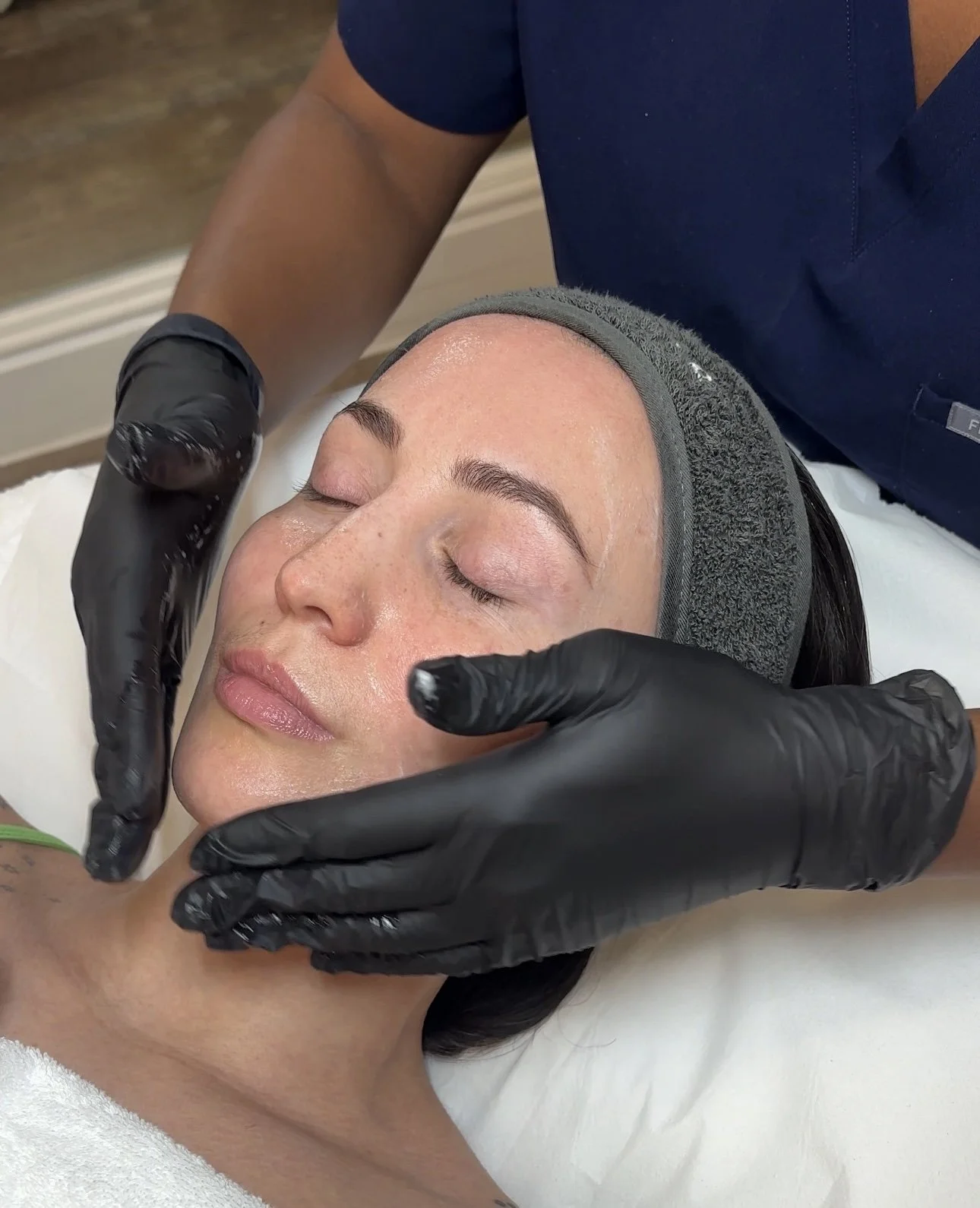 Microneedling Ilkley